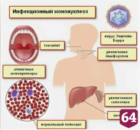 Саратовские врачи спасли ребенка с «болезнью поцелуев»